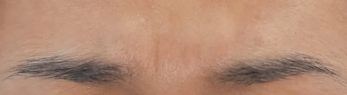 Before: 眉间除皱针