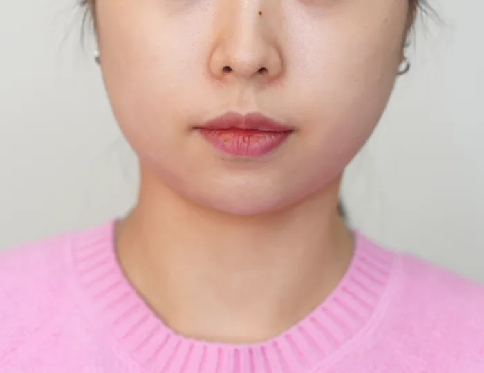 After: HaruFit™ Light