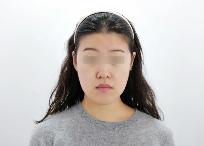 Before: CO2激光点痣