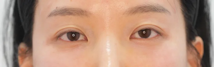 After: 泪沟填充