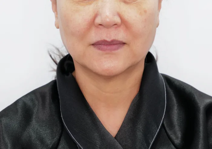 Before: 线雕