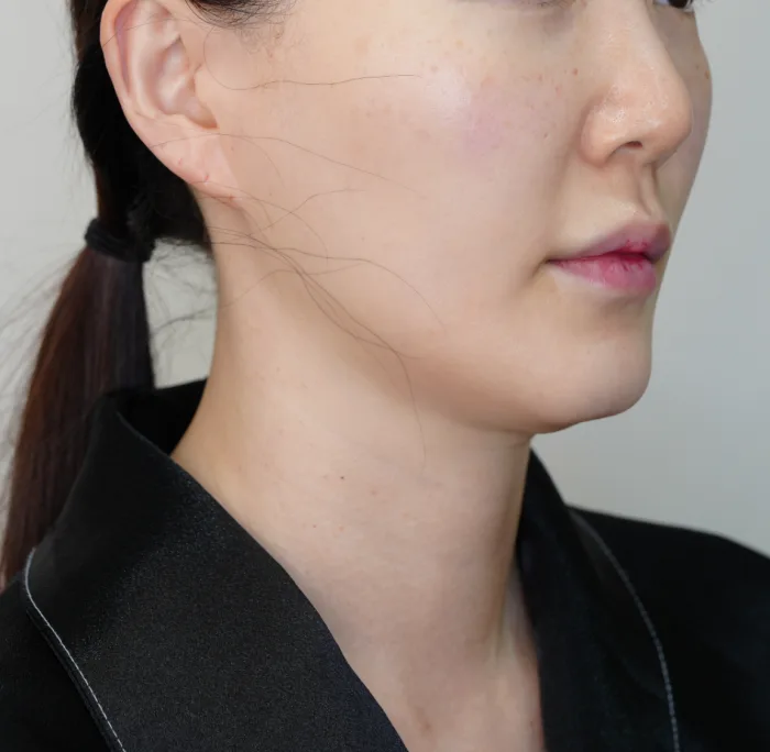 Before: 钛提升