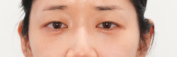 After: 卧蚕填充