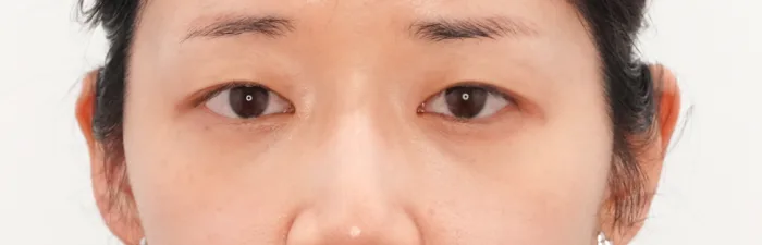 Before: 卧蚕填充
