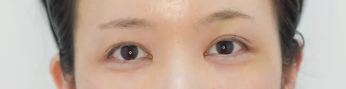 After: 卧蚕填充