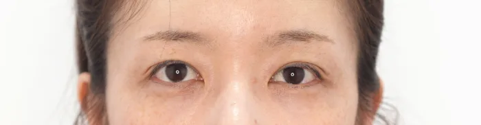 Before: 卧蚕填充