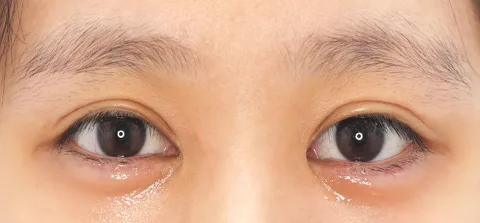 After: 卧蚕填充