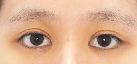 Before: 卧蚕填充
