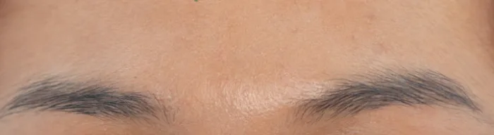 After: 眉间除皱针