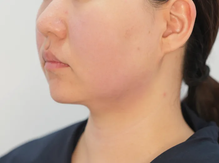 After: InMode FX