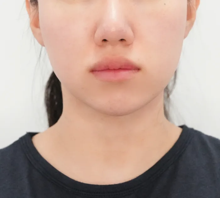 After: 乔雅露 Skin