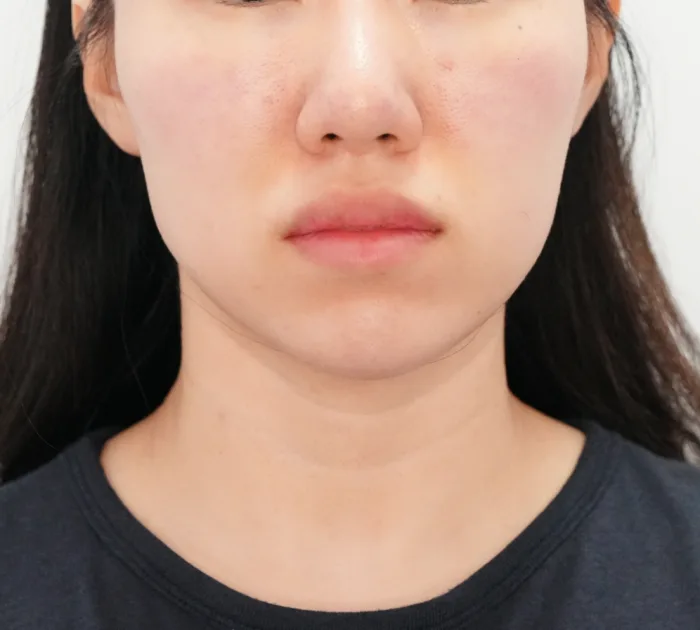 Before: 乔雅露 Skin