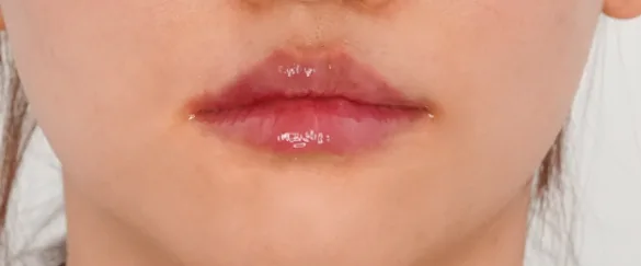 After: 嘟嘟唇