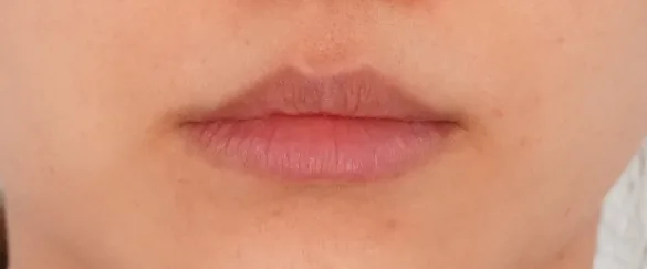 Before: 嘟嘟唇