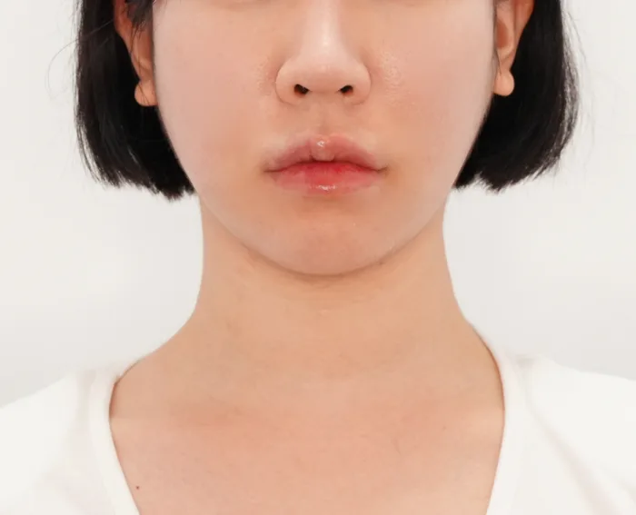 After: 嘟嘟唇