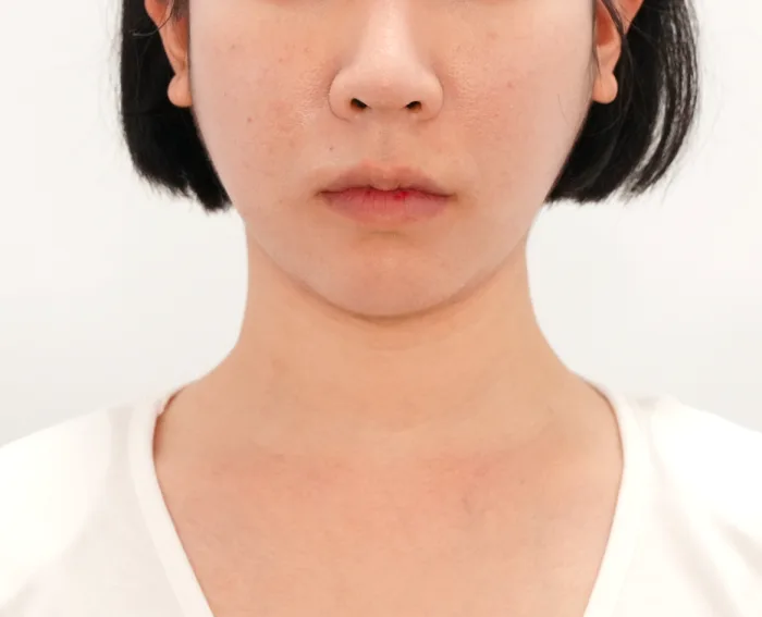 Before: 嘟嘟唇