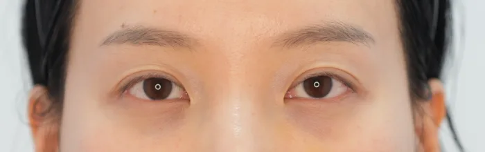 Before: 泪沟填充