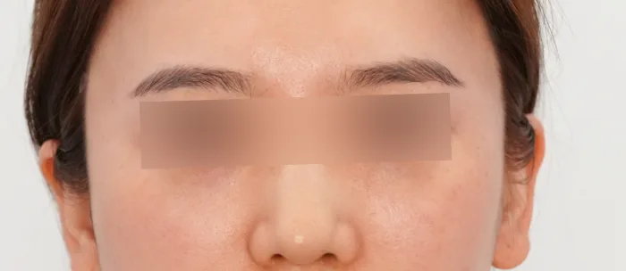 After: 太阳穴玻尿酸填充
