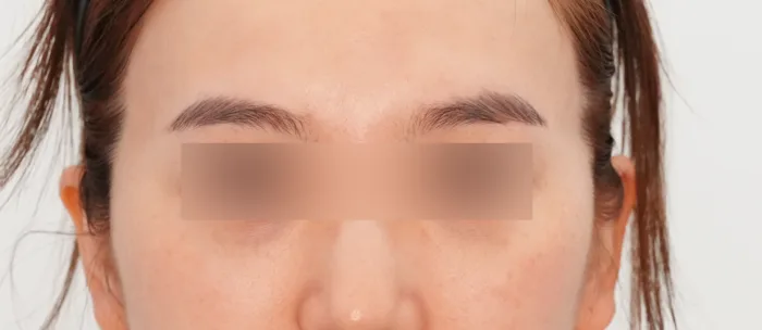 Before: 太阳穴玻尿酸填充