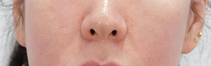 After: 线雕