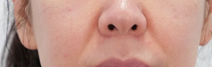 Before: 线雕