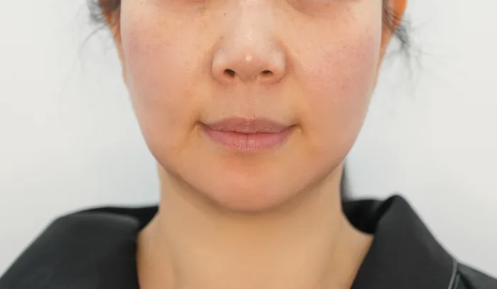 After: 钛提升